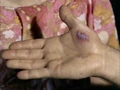 Miri disease.jpg