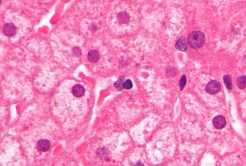 Ground glass hepatocytes high mag cropped