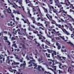 Sclerosing rhabdomyosarcoma