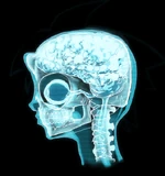 Timmy's X-ray that Dr. Singh took while he was asleep to illustrate the bony protuberance on his skull