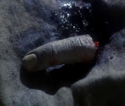 Kessick's finger.
